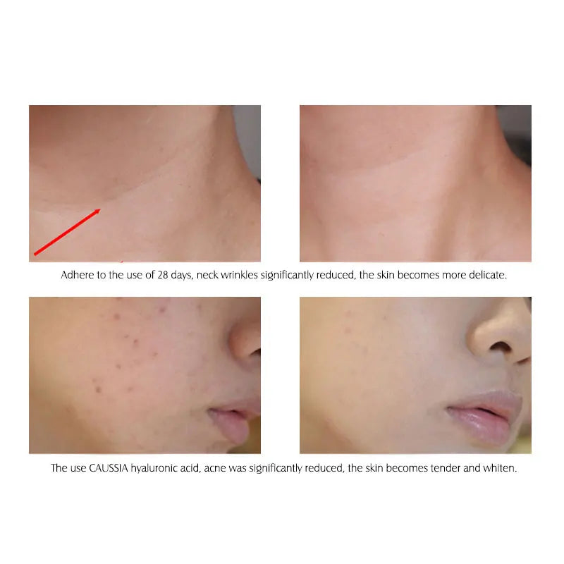 ARTISCARE Hyaluronic Acid Serum VC Essence Face Cream Moisturizing Acne Aging & Wrinkles Repair 10PCS