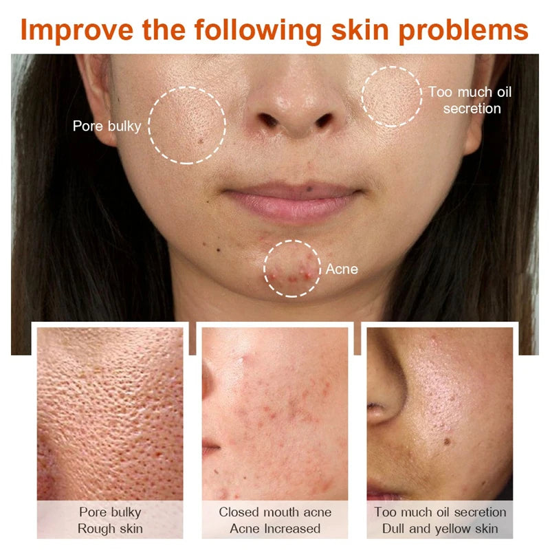 Stubborn Spot Remover Serum | Anti-Pigmentation Fade Melasma Clear Blemishes - 7 Day Challenge Results