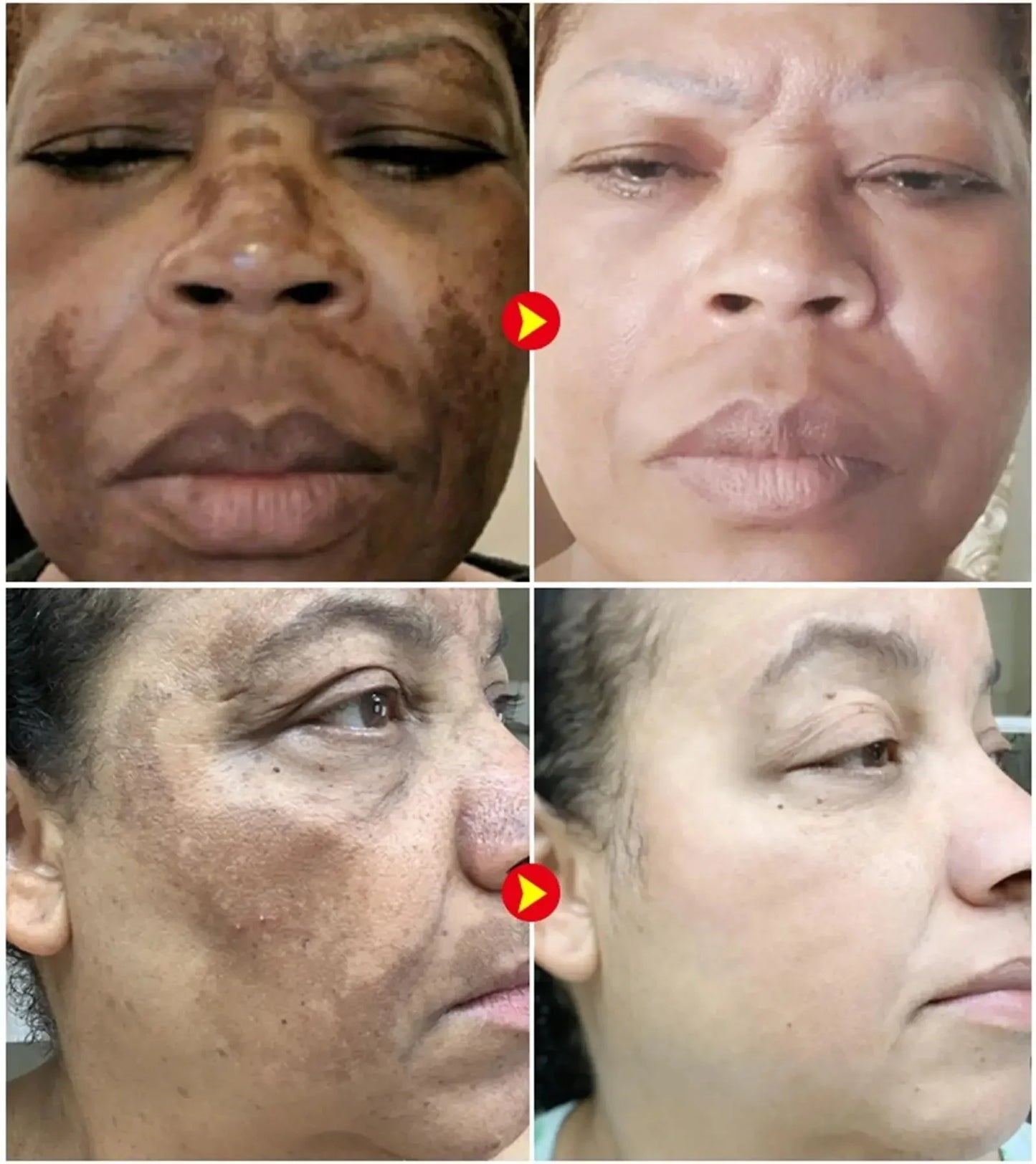 Vitamin C Whitening Freckles Serum Stick Remove Melasma Dark Spots Corrector Lighten Melanin Acne Anti-Aging Brighten Skin Care