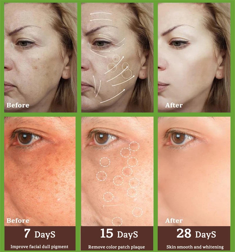 Stubborn Spot Remover Serum | Anti-Pigmentation Fade Melasma Clear Blemishes - 7 Day Challenge Results