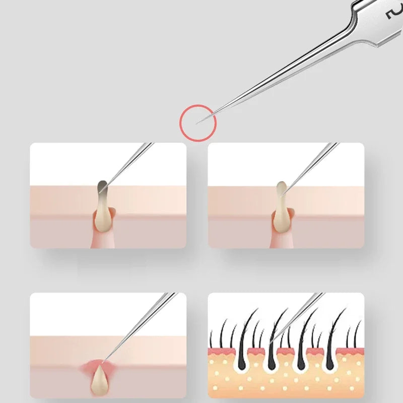 1/2/3pcs Acne Removal Needle and Clip Stainless Steel Tool Blackhead Removal Blemishes Facial Skin Care Beauty Facial Pore Clean