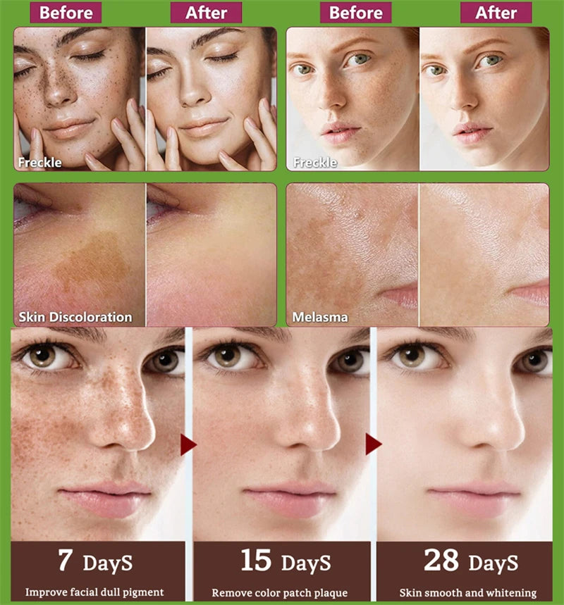 Stubborn Spot Remover Serum | Anti-Pigmentation Fade Melasma Clear Blemishes - 7 Day Challenge Results