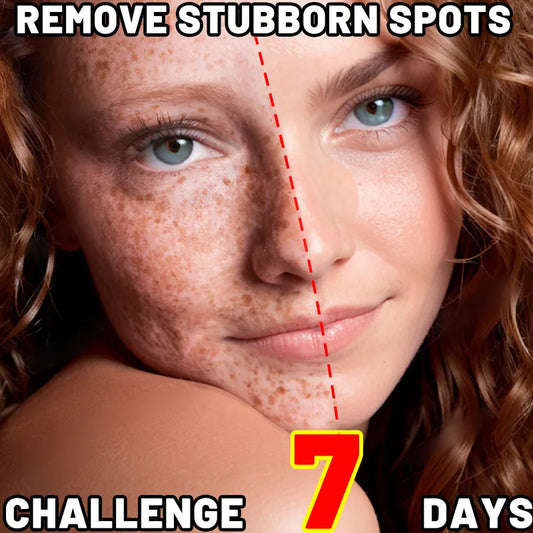 Stubborn Spot Remover Serum | Anti-Pigmentation Fade Melasma Clear Blemishes - 7 Day Challenge Results